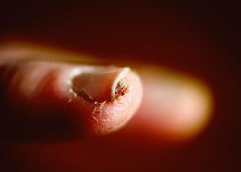 Your Brittle Nails Are a Check Engine Light: The Iron Supply Chain Crisis Your Body Is Hiding