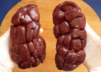 Losartan and the Kidney: A Clinical Narrative of Protection, Peril, and Precision